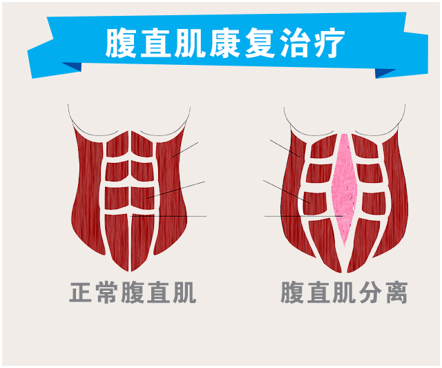 腹直肌康复治疗